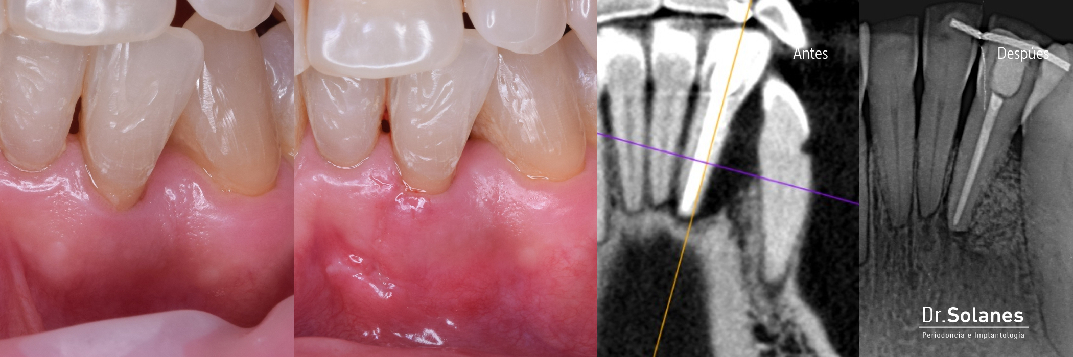 Regeneración periodontal