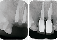 Caso clínico de implantología: radiografías de implantes dentales antes y después de la colocación de coronas