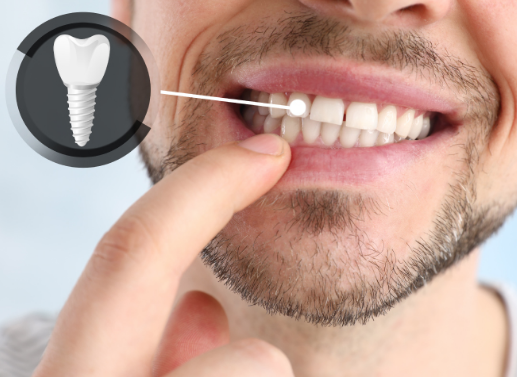 6 falsas creencias sobre los implantes dentales