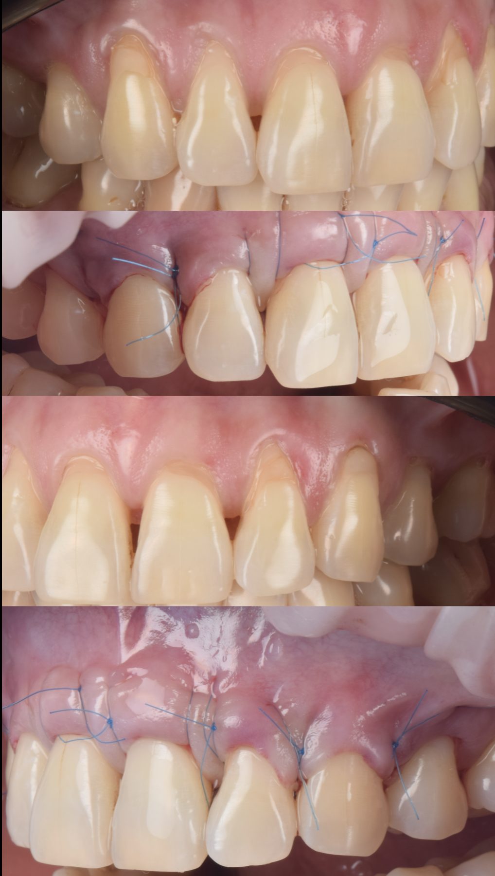Caso clínico: manejo de recesión gingival, secuencia quirúrgica