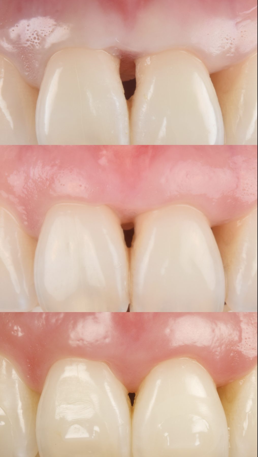 Caso clínico: manejo de papila interdental